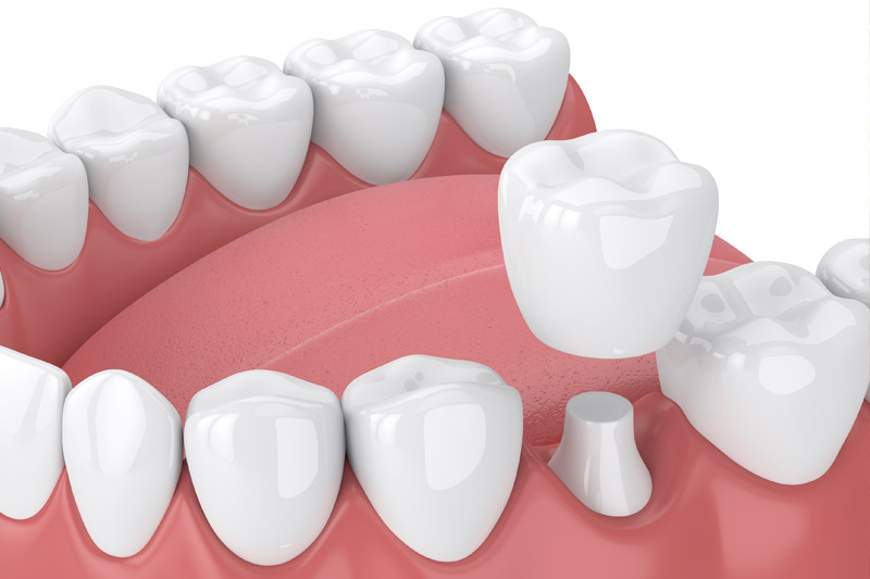 Dental Crowns in San Luis Obispo