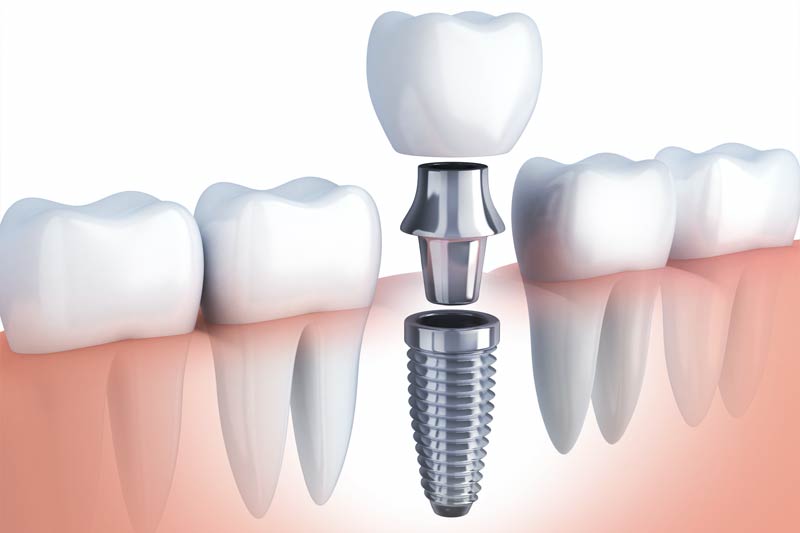 Implants Dentist in San Luis Obispo