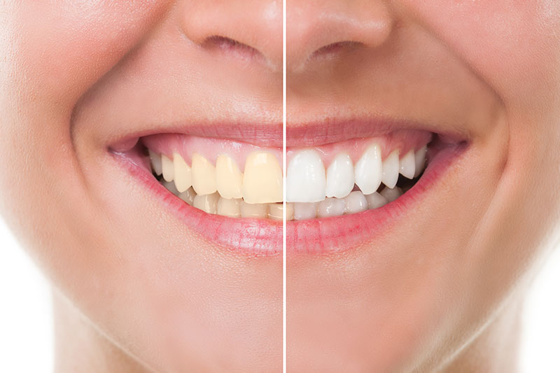 Teeth Whitening in San Luis Obispo